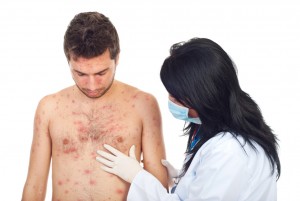 skin disease 300x201 - Causes and home remedies for psoriasis