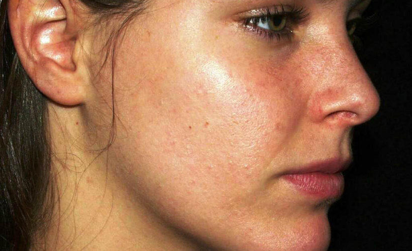 How to Get Rid Of Blackheads on Chin