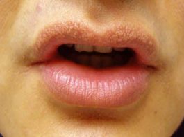 How to Get Rid of Fordyce Spots on Lips