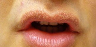 How to Get Rid of Fordyce Spots on Lips
