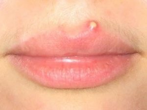 How to Get Rid Of a Pimple on Your Lip