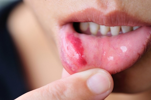 How to Get Rid Of a Pimple on Your Lip