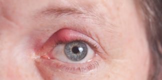 Expert suggested ways to prevent eye pimple or stye