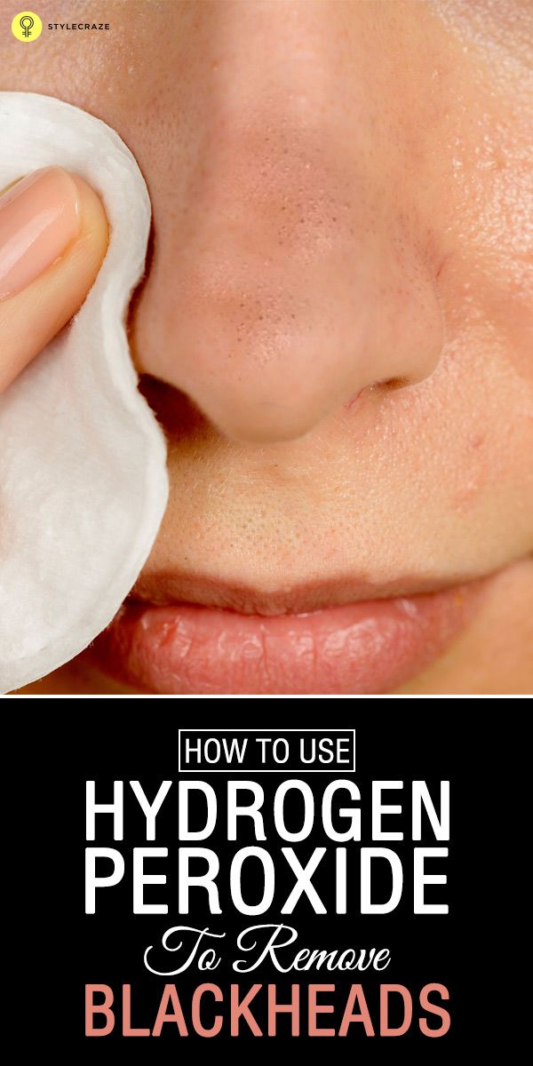 How to Use Hydrogen Peroxide To Remove Blackheads