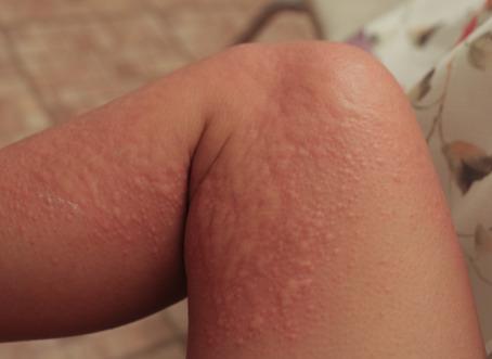 5 Home Remedies for Getting Rid of Hives