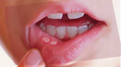 Home Remedies For Treating Canker Sores