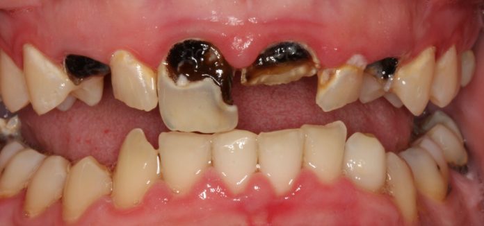 Ten Ways To Prevent Tooth Decay Naturally