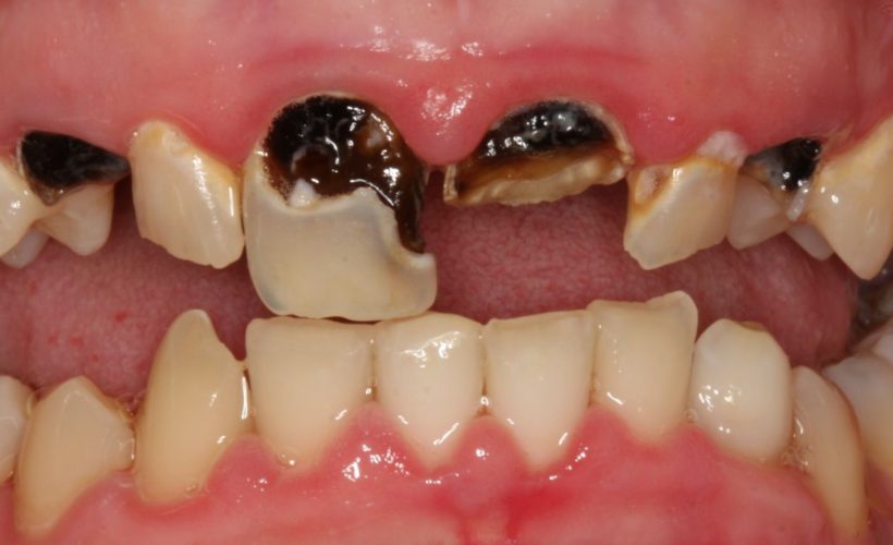Ten Ways To Prevent Tooth Decay Naturally Ten Ways To Prevent Tooth Decay Naturally