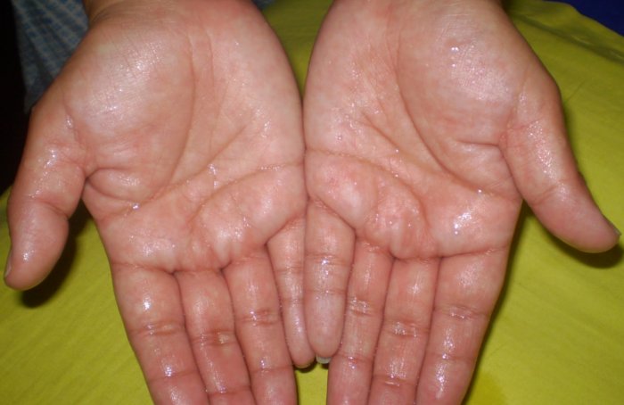 8 Best Home Remedies For Sweaty Hands