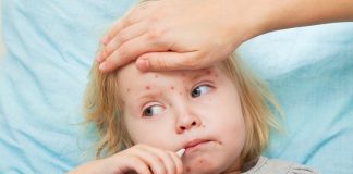 Natural Home Remedies For Measles