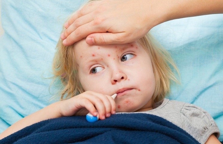 Natural Home Remedies For Measles