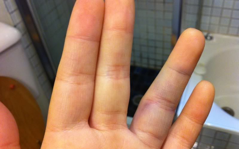 Home remedies for swollen finger