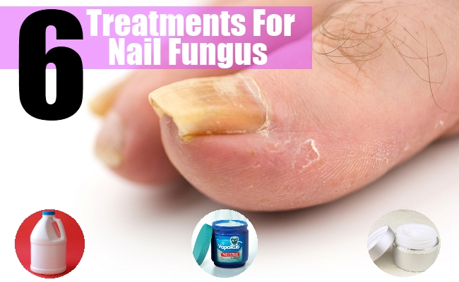 Home Remedies For Nail Fungus