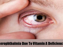 Symptoms of Vitamin A Deficiency