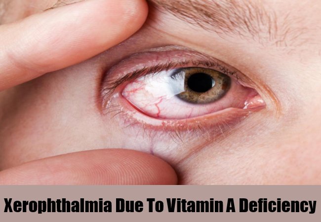 Symptoms of Vitamin A Deficiency