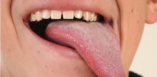Home Remedies for Burning Tongue
