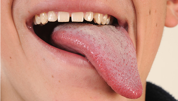 Causes and home Remedies for Burning Tongue