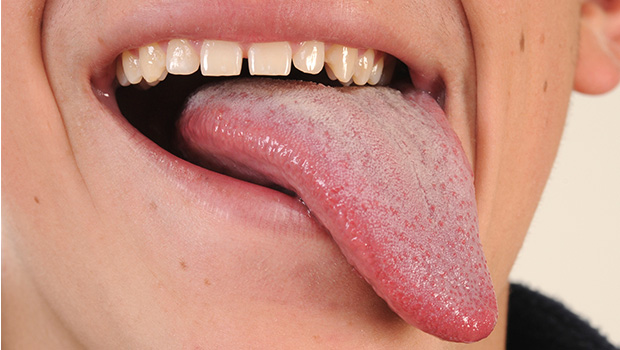 Home Remedies for Burning Tongue