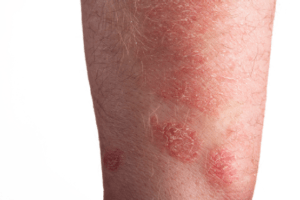 different types of skin diseases