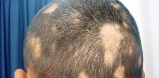 causes of white hair patches