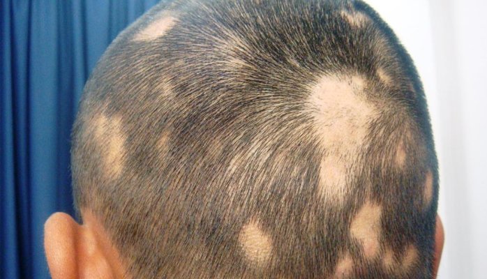 causes of white hair patches