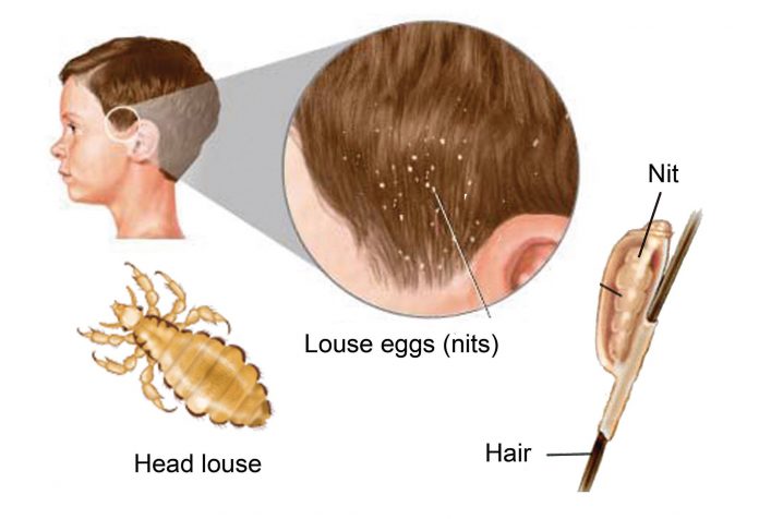 treat Head lice with Tea Tree Oil