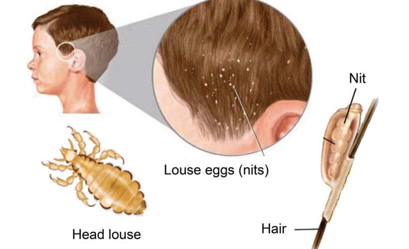 treat Head lice with Tea Tree Oil treat Head lice with Tea Tree Oil
