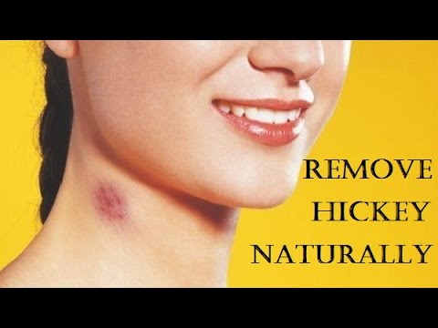 Best 8 home remedies to Get Rid of Hickeys Fast