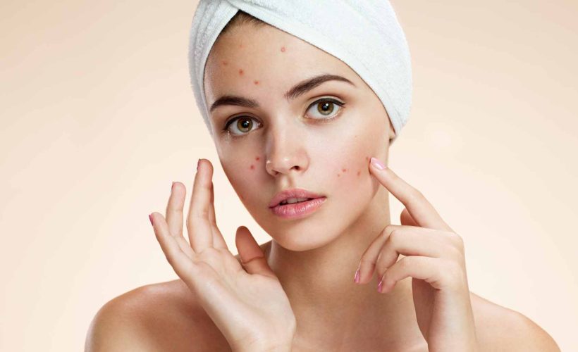Homemade face mask for acne