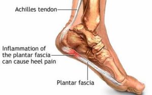 Home Remedies for Heel Spurs