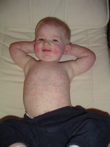 Fifth disease 225x300 225x300 - How To Get Rid of Heat Bumps on skin