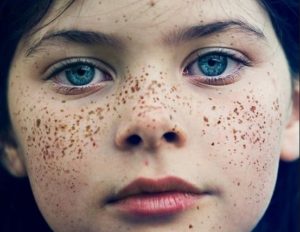 How to get rid of freckles on face and lips fast permanently 300x232 - How To Get Rid Of Freckles Naturally
