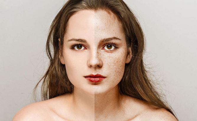 How To Get Rid Of Freckles Naturally - Yabibo