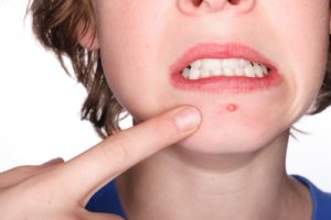  Acne tell about your Health