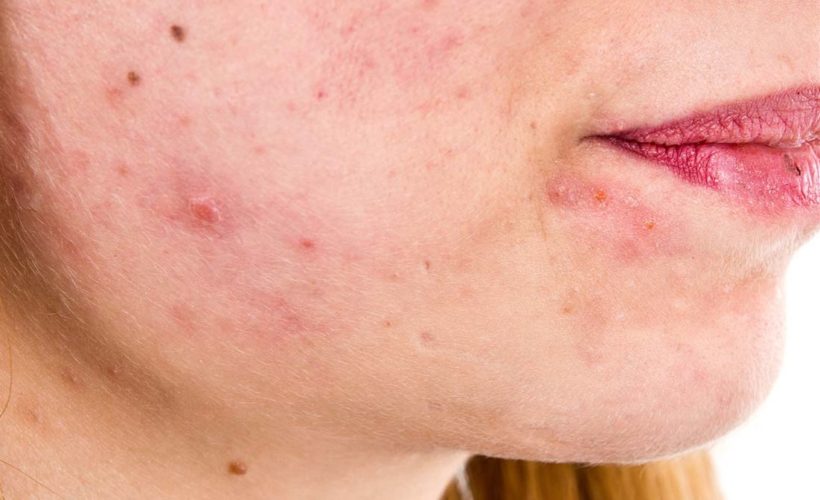 Home Remedies to Treat Seborrheic Dermatitis Hair Loss