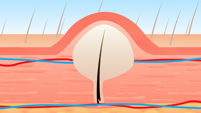 Methods To Cure Ingrown Hair