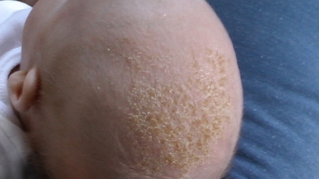 seborrheic dermatitis cradle cap - Home Remedies to Treat Seborrheic Dermatitis Hair Loss
