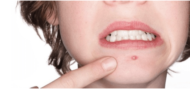 pimple 1 - Things You Should Know Before You Pop a Pimple