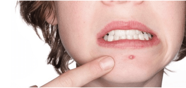 Things You Should Know Before You Pop a Pimple