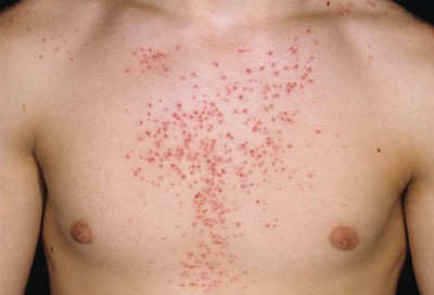 chest acne  - How To Get Rid Of Chest Acne