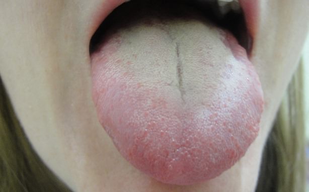 how to get rid of white tongue