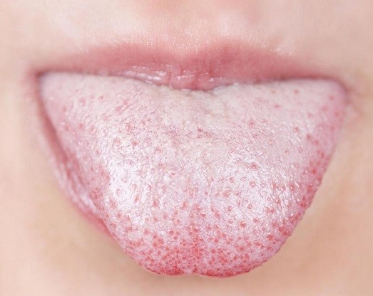 how to get rid of white tongue