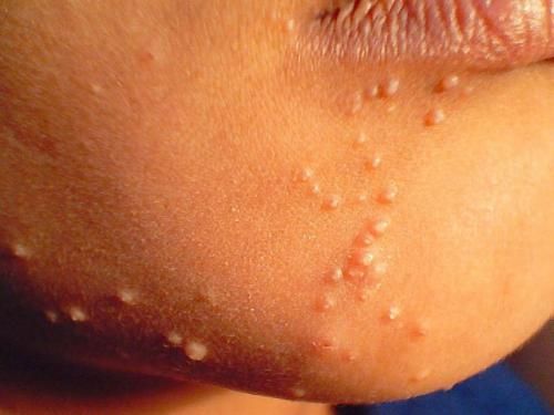 Home Remedies for Molluscum Contagiosum