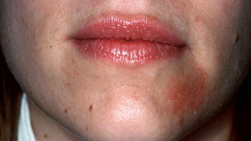 Apple cider vinegar perioral dermatitis Does ACV