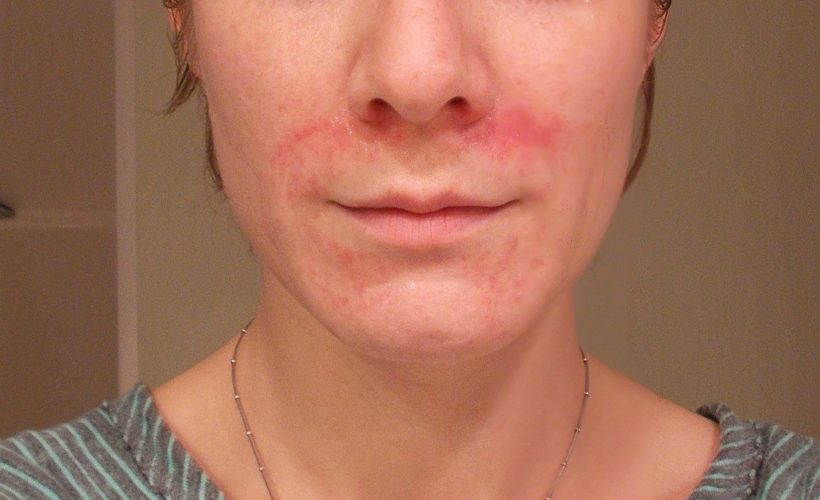 Home Remedies for Perioral Dermatitis