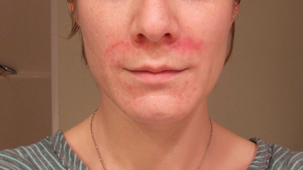 at home remedies for dermatitis