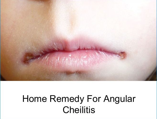 Home Remedies for Angular Cheilitis