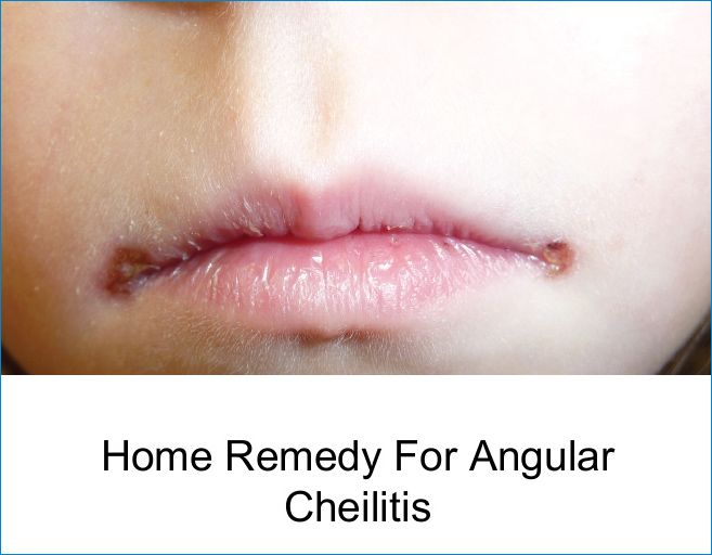 Home Remedies for Angular Cheilitis
