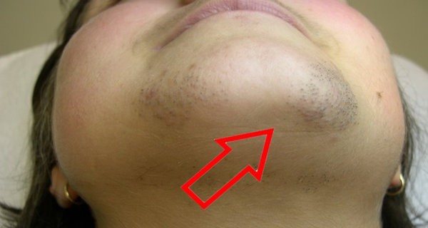 Embarrassing Chin Hair No Woman Should Ever Ignore