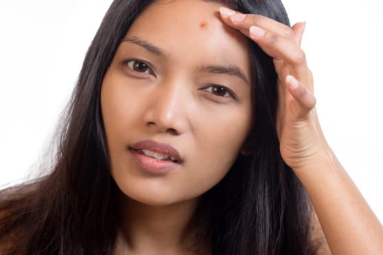 Various Types Of Acne And How To Identify Them